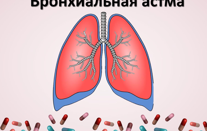 Что такое бронхиальная астма и как ее предотвратить? Рассказывают специалисты